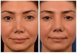 نمونه کار بهترین جراح ترمیمی بینی در تهران