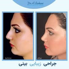 نمونه عمل بهترین جراح ترمیمی بینی در تهران